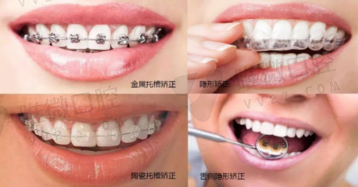 纯钛假牙和全瓷假牙区别,纯钛烤瓷牙可以做磁共振吗(图1)